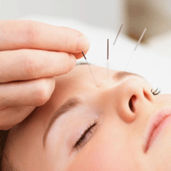Medical-Acupuncture
